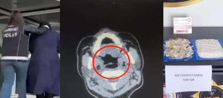 doktorlar bile inanamadi midesinden tam 500 gram metamfetamin cikti 2WtT9hvp.jpg
