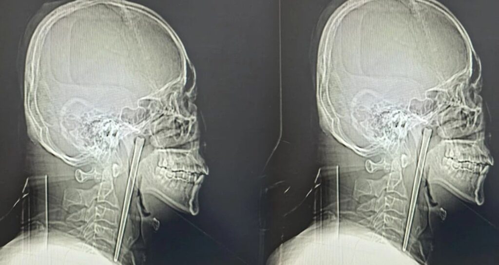 8-yil-boyunca-bogazindakiyle-yasadi-yDHSxrgA